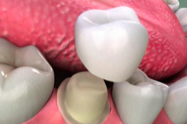 补牙发炎会发烧吗(补牙发炎会发烧吗多少度)