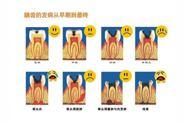 蛀牙最严重看看(蛀牙最严重看看什么科室)