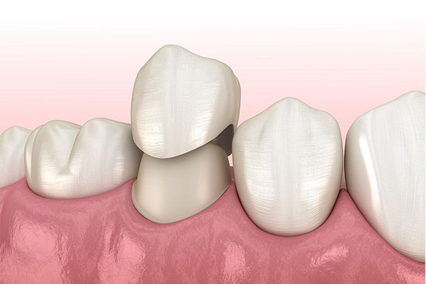 烤瓷牙贴面掉了怎么办啊多少钱(烤瓷牙贴面掉了怎么办啊多少钱啊)