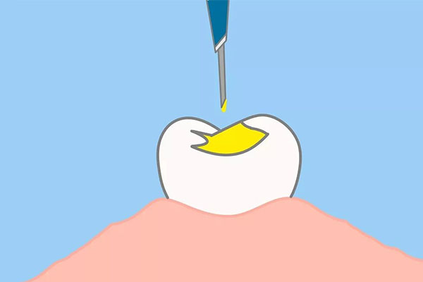 前牙怎么根管治疗