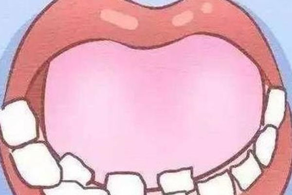 缺六龄牙可以矫正不拔吗(缺六龄牙可以矫正不拔吗多少钱)