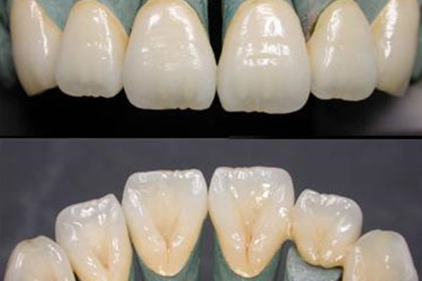 蓝瓷贴面和玻璃陶瓷贴面的区别在哪(蓝瓷贴面和玻璃陶瓷贴面的区别在哪儿)