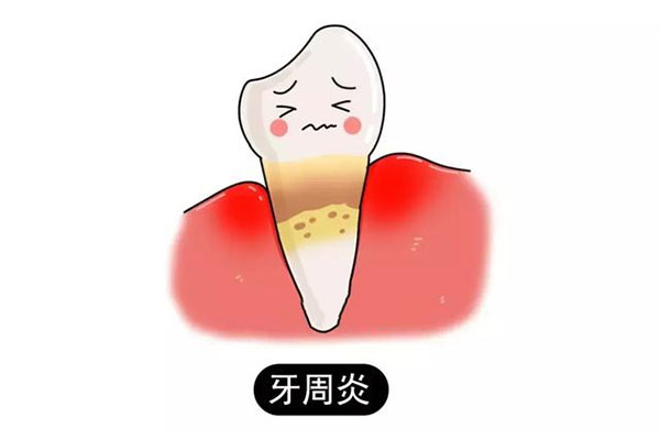 智齿牙周炎的治疗(智齿牙周炎的治疗方案)