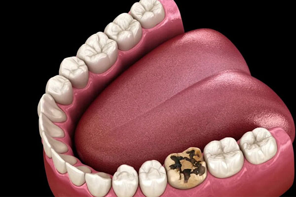 牙齿蛀牙疼痛该怎么办吃什么药(牙齿蛀牙疼痛该怎么办吃什么药管用)