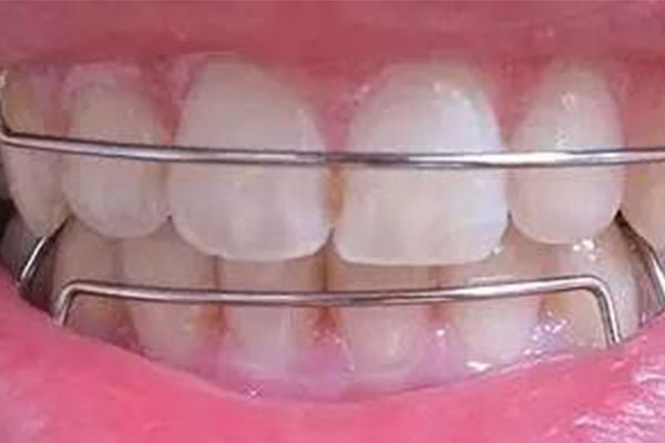 牙齿矫正器戴多久有效果(牙齿矫正器戴多久见效)