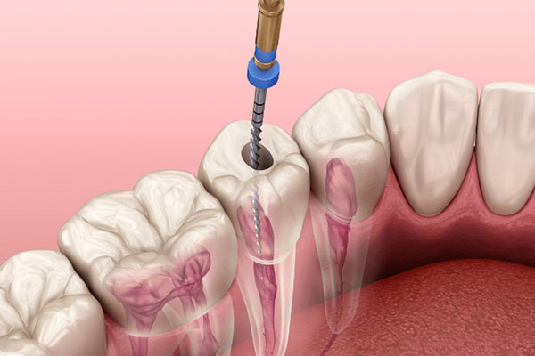 做完根管治疗加牙冠 能使用多久(根管治疗后加牙冠牙齿的寿命)