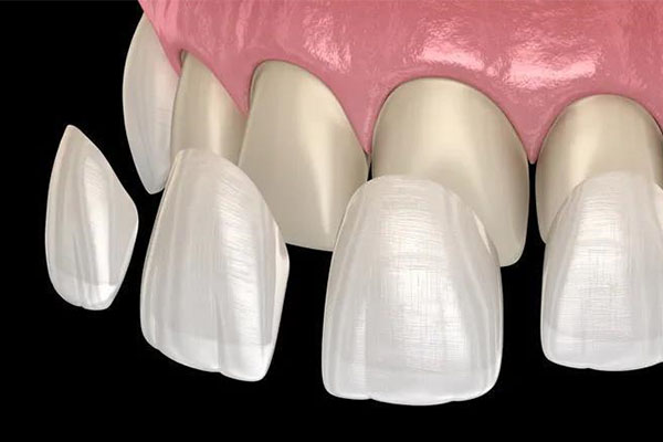 牙贴面有什么缺点和不足之处呢(牙贴面有什么缺点和不足之处呢)