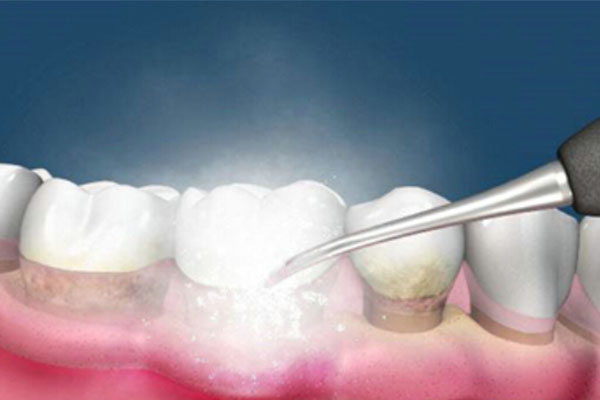 牙黄变白最实用的方法是什么呢吃什么药(牙黄变白最实用的方法是什么呢吃什