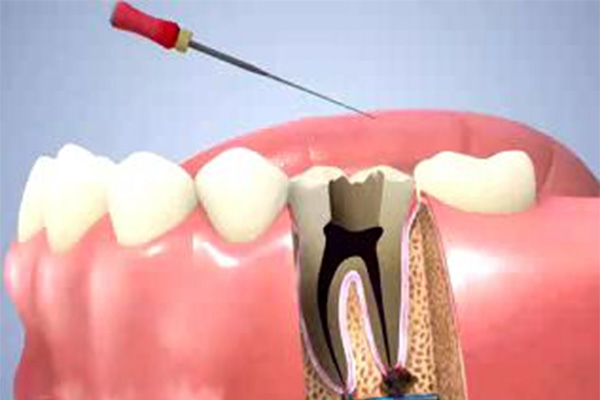 根管治疗后牙疼能戴牙冠吗(根管治疗后牙疼能戴牙冠吗图片)