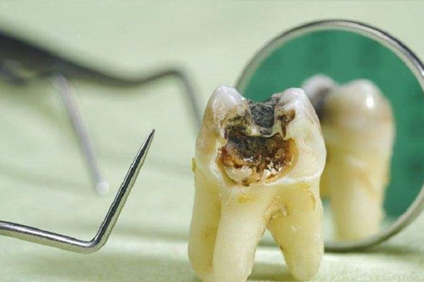 牙体缺损粘接修复方法步骤(牙体缺损粘接修复方法步骤图)