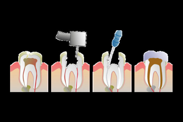 12岁就根管治疗早不早(12岁儿童根管治疗的危害)