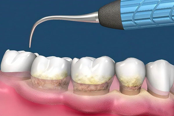 超声波洁牙抛光牙齿会白吗为什么不能用(超声波洁牙抛光牙齿会白吗为什么不