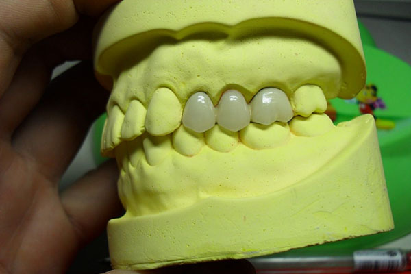 树脂牙齿贴片对牙齿有伤害吗多少钱一次(树脂牙齿贴片怎么样)