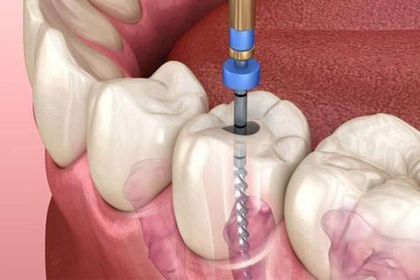 根管炎能自愈吗多久能拔牙呀(根管炎能自愈吗多久能拔牙呀)