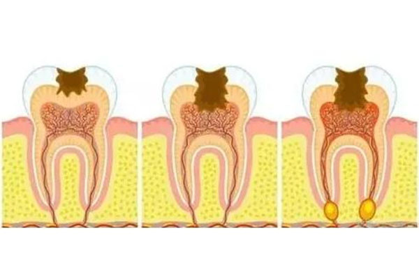 12岁男孩蛀牙怎么治疗最好(12岁男孩蛀牙怎么治疗最好的方法)