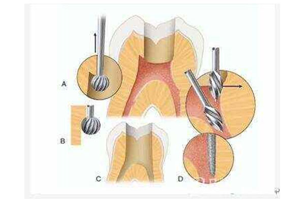 根管治疗后戴牙冠胀痛(根管治疗后戴牙冠胀痛怎么办)