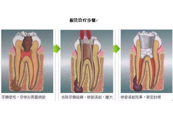 做了根管治疗的牙齿做牙套好还是做嵌体好(做了根管治疗的牙齿