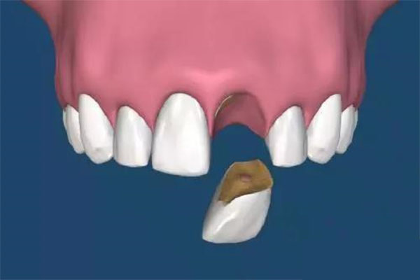 中年人掉牙齿暗示什么(中年人掉牙齿暗示什么预兆)