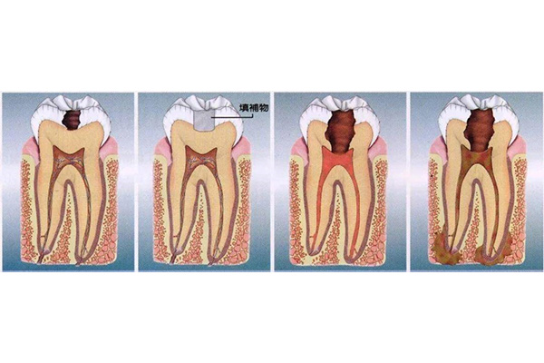 补牙之后多久可以吃硬的东西(补牙以后多久可以吃硬的东西)