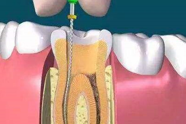 根管治疗扩根管后的步骤是(根管治疗扩根管后的步骤是)