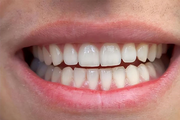 抽烟牙齿上有黑渍怎么去除(抽烟牙齿上有黑渍怎么去除小妙招)