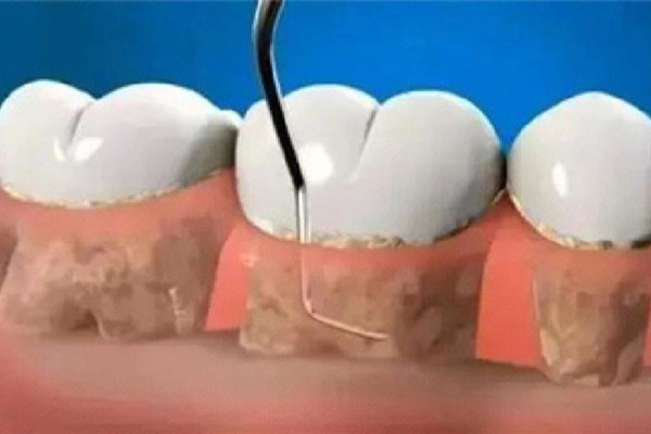 洁牙后的注意事项有哪些和名称呢(洁牙后的休息事项)