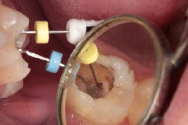 做完根管治疗的牙齿一定要做牙套吗(做完根管治疗的牙齿一定要做牙套吗图片