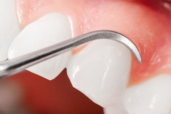 做瓷贴面后悔了怎么处理(做瓷贴面后悔了怎么处理呢)