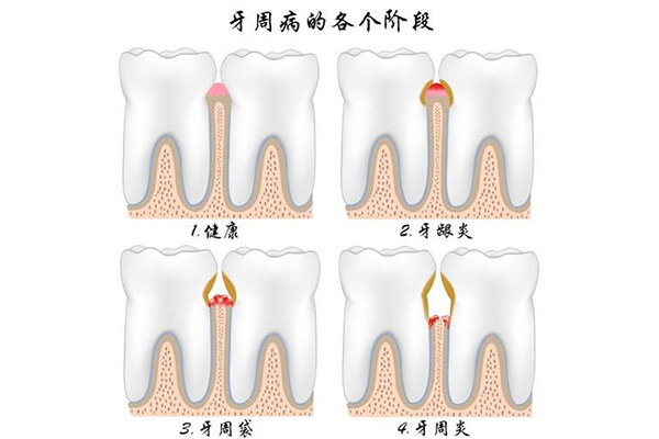 什么叫做牙周炎症状表现(什么叫做牙周炎症状表现呢)