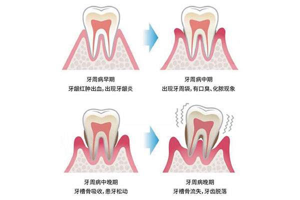 小孩得牙周炎吃什么药效果好的快(小孩得牙周炎吃什么药效果好的快呢)