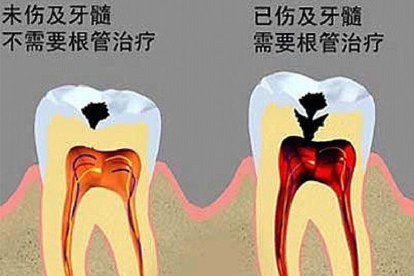 口腔牙齿根管治疗(口腔牙齿根管治疗视频)