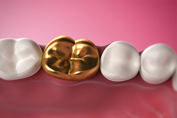 烤瓷牙多少年换一次(烤瓷牙多少年换一次好)