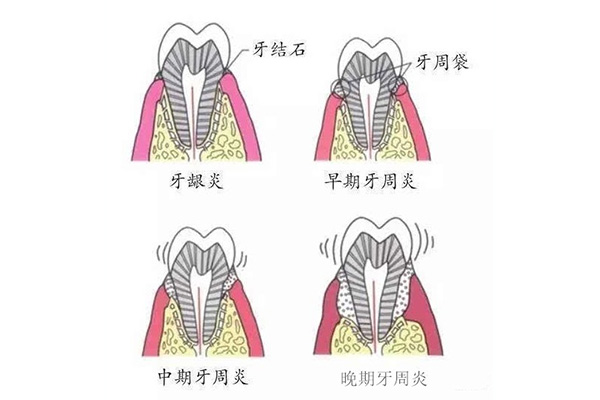 牙周炎怎么治疗好的快点(牙周炎怎么治好得快)