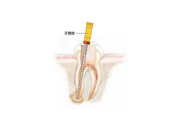 根管治疗流程及费用表格(根管治疗流程及费用表格图片)