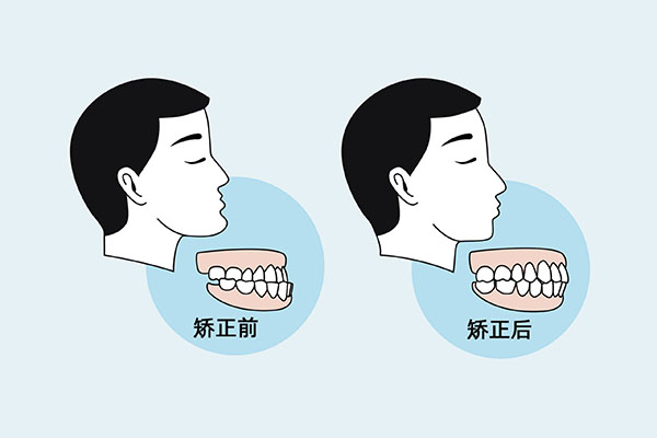 牙齿矫正变成了天包地(牙齿矫正了还