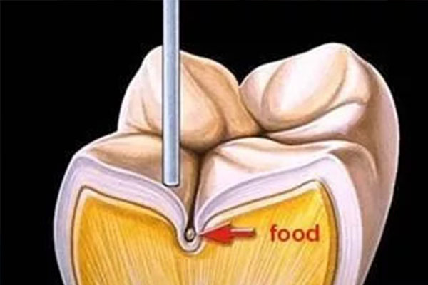 关于儿童窝沟封闭项目的申请(关于儿童窝沟封闭项目的申请怎么写)