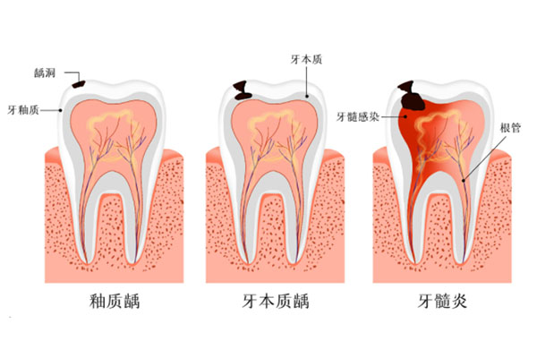 牙髓炎治疗不彻底(牙髓炎治疗不彻底会变成牙髓炎吗)