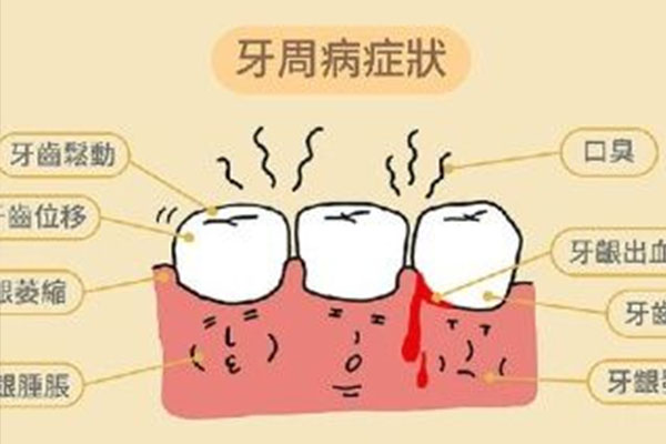 牙周炎一般有什么症状吗(牙周炎一般有什么症状吗怎么治疗)