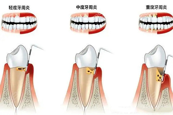 牙周炎怎么形成的原因(牙周炎是什么原因导致的)