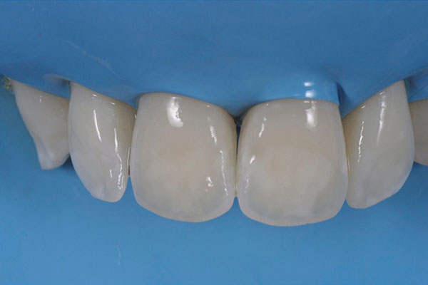 贴面牙齿制备过程(贴面牙齿制备过程图片)