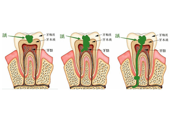 4岁孩子蛀牙有黑窟窿还能治吗(4岁孩子蛀牙有黑窟窿还能治吗视频)