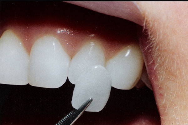 门牙贴面修复多少钱一颗啊及价格(门牙贴面修复多少钱一颗啊及价格表)