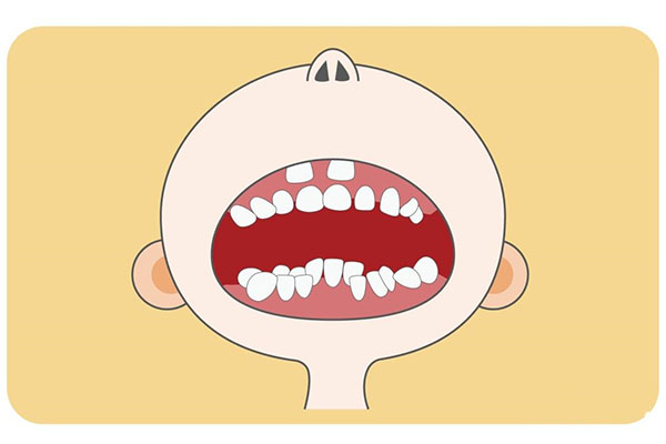 牙齿不齐类型(牙齿不齐类型有哪些