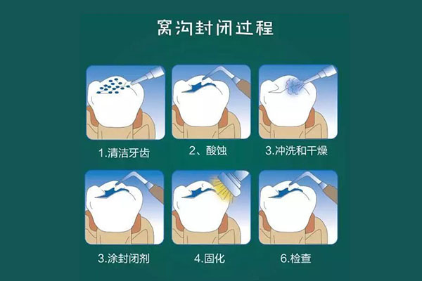 牙齿涂氟有什么用处(牙齿涂氟有什么用处和功效)