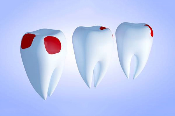 牙体缺损修复时修复体常用的固位形有(牙体缺损修复体的固位原理)