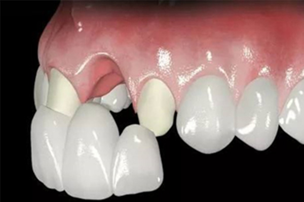 烤瓷牙安装后如何取下(烤瓷牙安装后如何取下牙套)