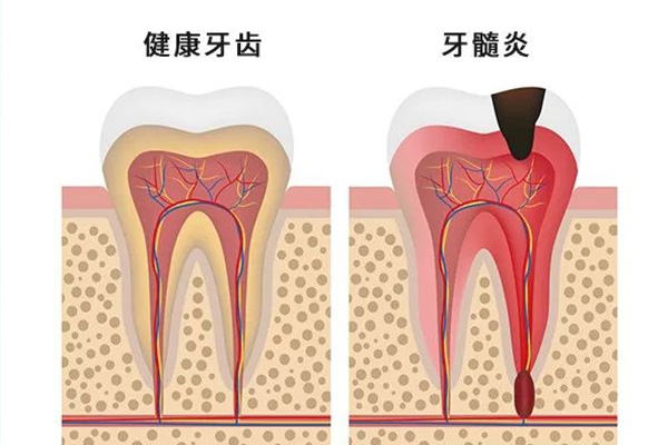 牙髓炎止疼药有用吗多少钱(牙髓炎止疼药有用吗多少钱一瓶)