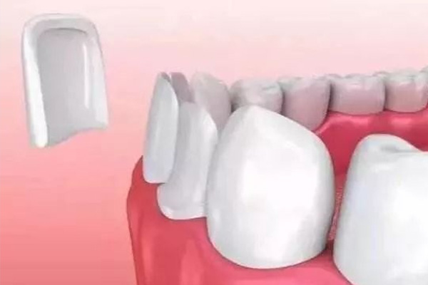 铸瓷贴面是什么意思(铸瓷贴面是什么材料)