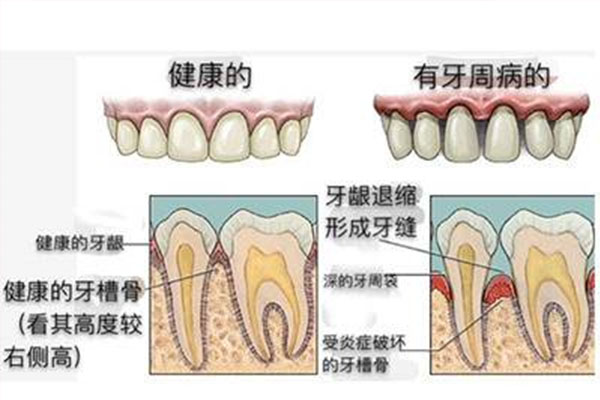 牙周炎主要症状不包括什么(牙周炎主要症状不包括什么病)