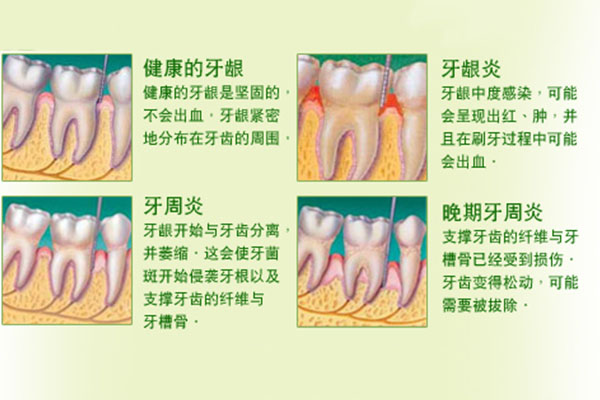 牙周病口臭吃什么药效果好的快(牙周病口臭吃什么药效果好的快呢)